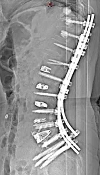 X-ray of a spine with metal rods and screws after surgical implantation for stabilization.