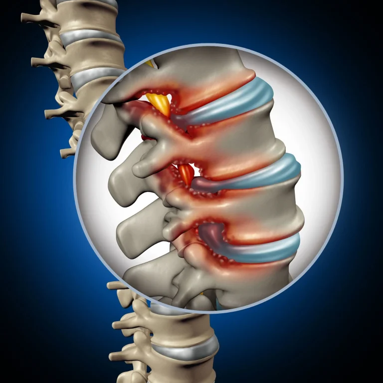 Illustration of a spinal column highlighting inflammation and nerve compression.