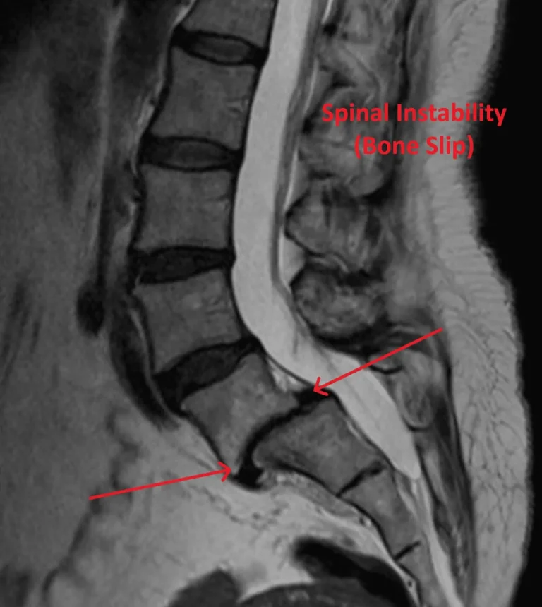 MRI of the spine showing spinal instability with labeled bone slip.