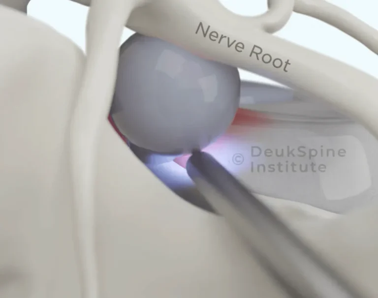 Benefits of Lumbar Deuk Laser Disc Repair