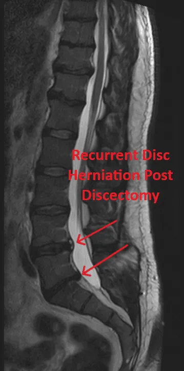 MRI of lumbar spine showing recurrent disc herniation post discectomy highlighted by arrows.