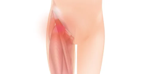 Hip-groin_pain