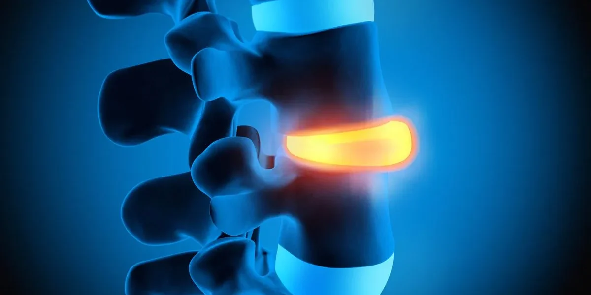 degenerative disc disease