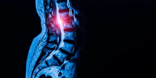 multilevel degenerative disc disease