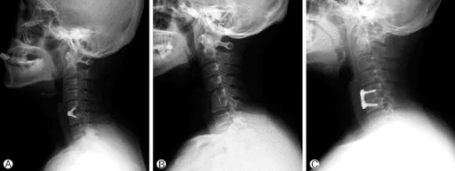 An xray highlighting the ACDF on the Cervical spine. 