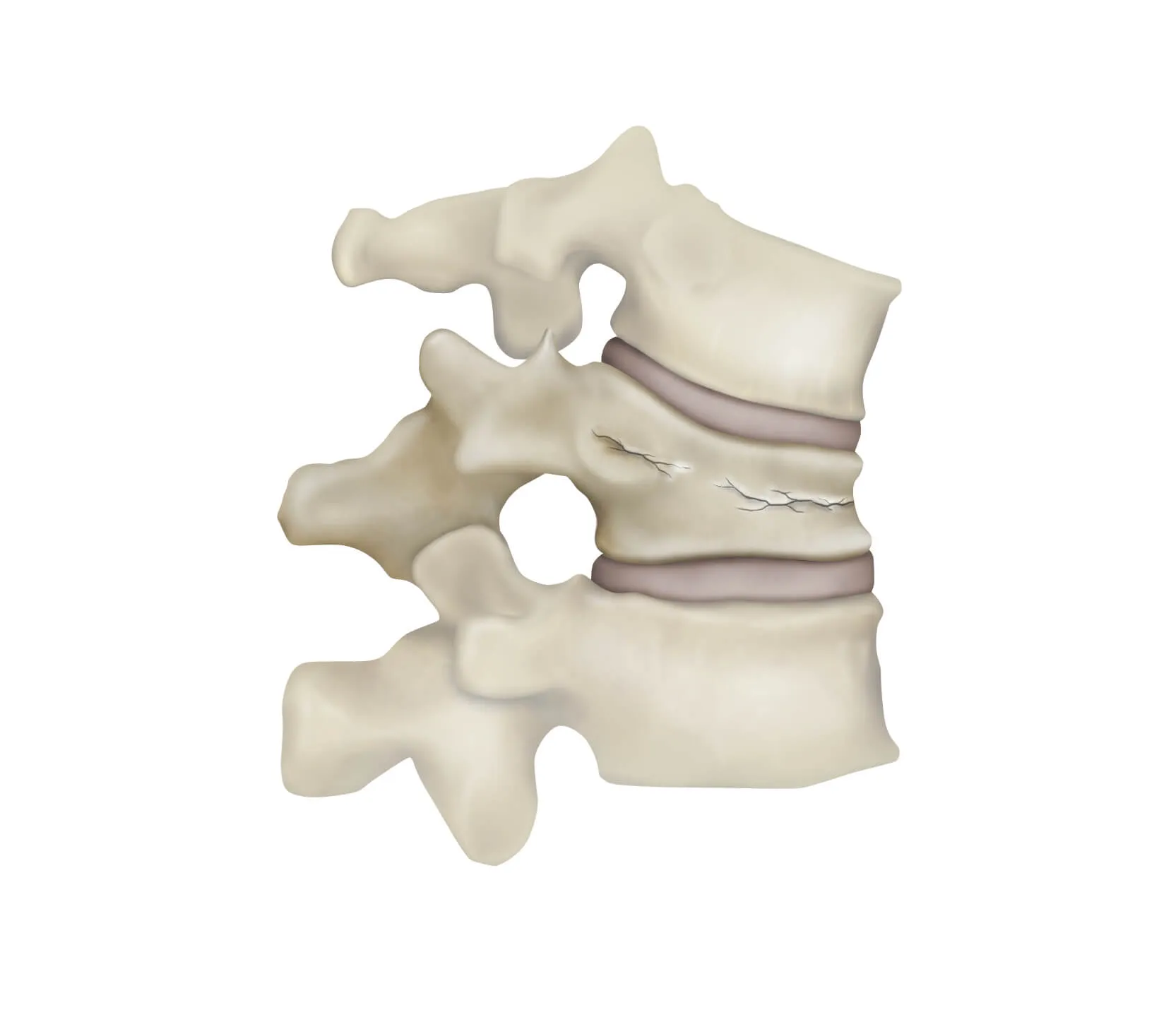 Illustration of a human cervical spine segment with visible fractures.