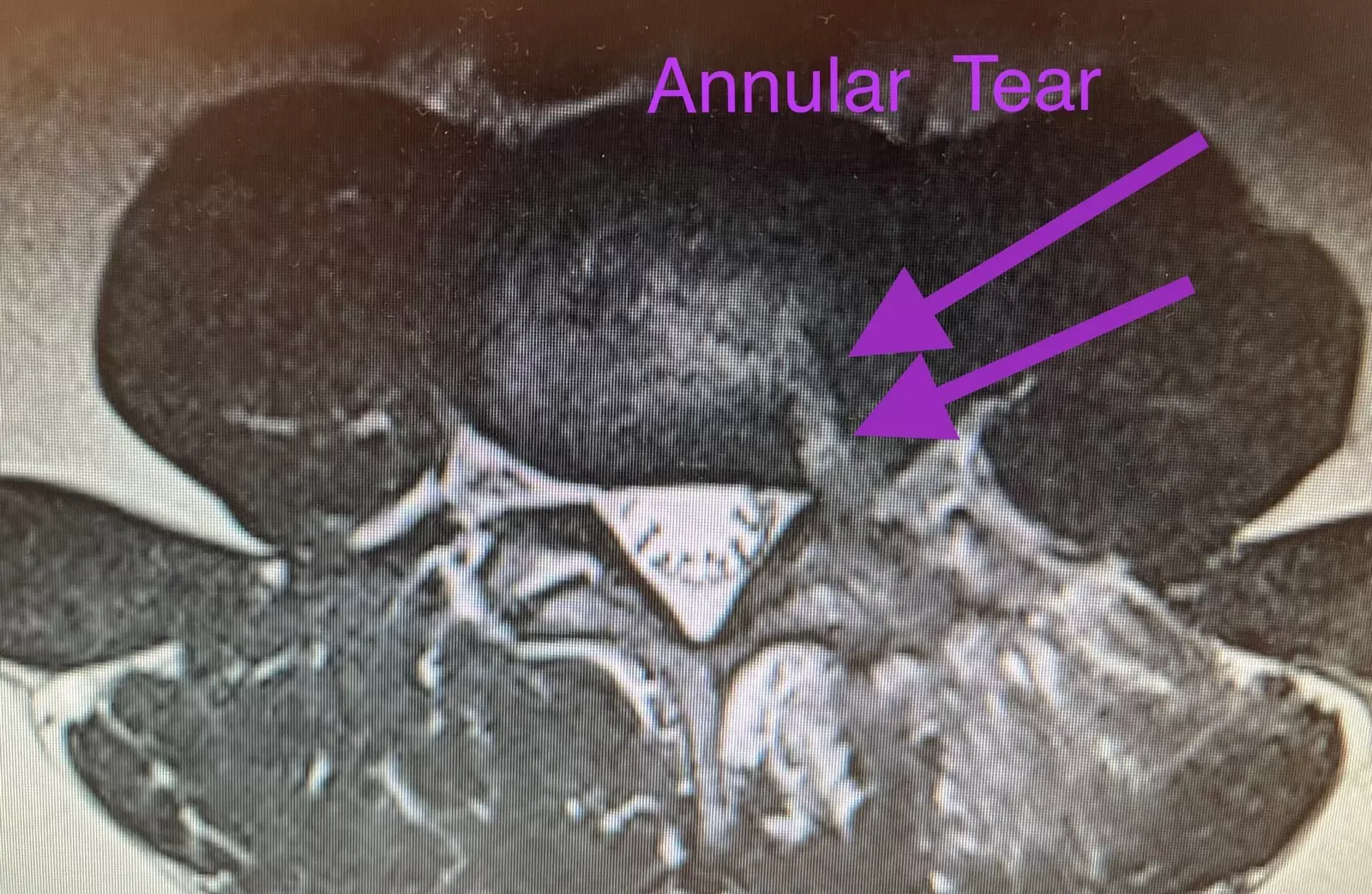 An axial view of a spine cross section showcasing annular tear with the arrows.