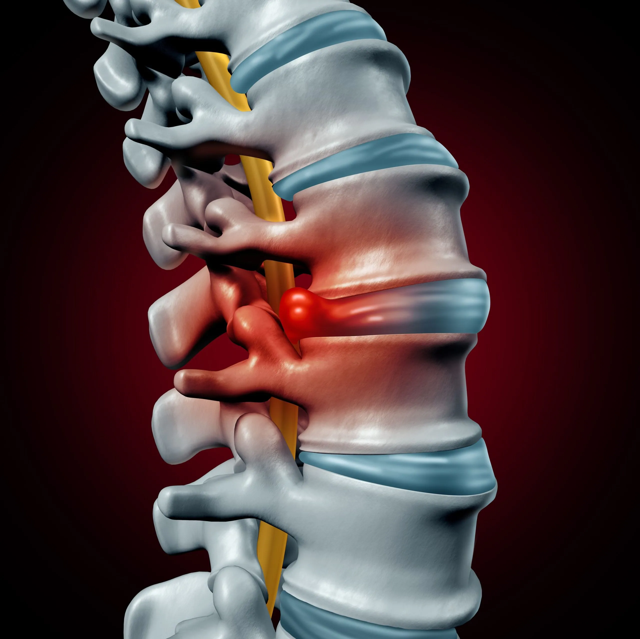 3D illustration of a spinal column highlighting a bulging disc.