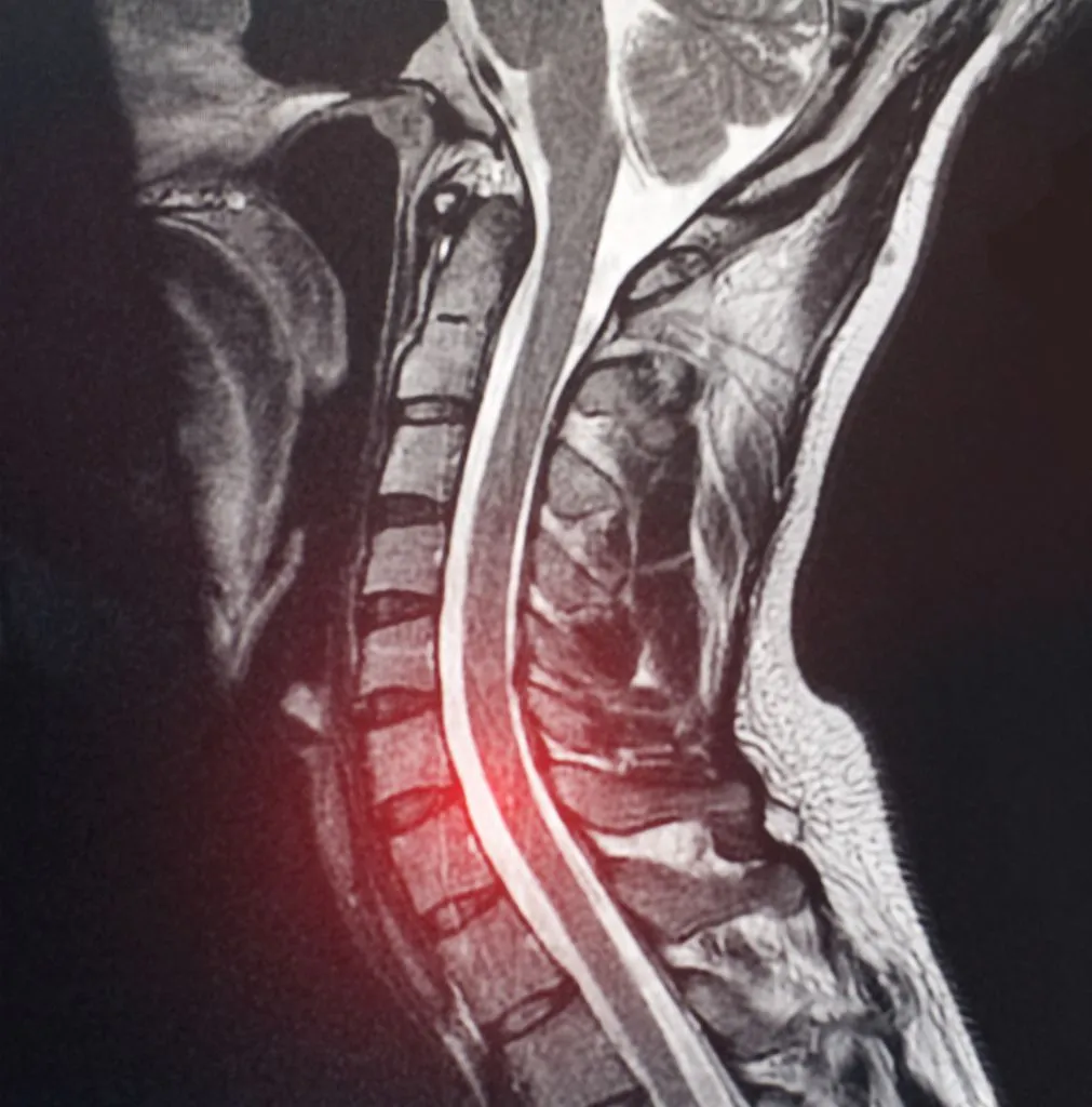 Spine MRI image