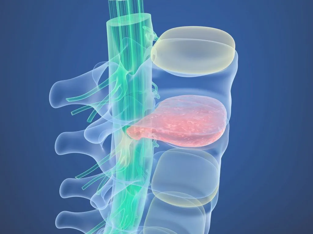 3D illustration of a human spine and spleen in a semi-transparent body showcasing a bulged disc.