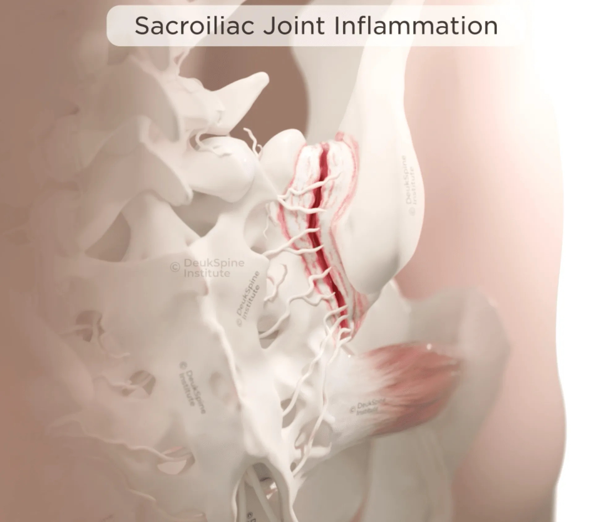 SI Joint Inflammation.png