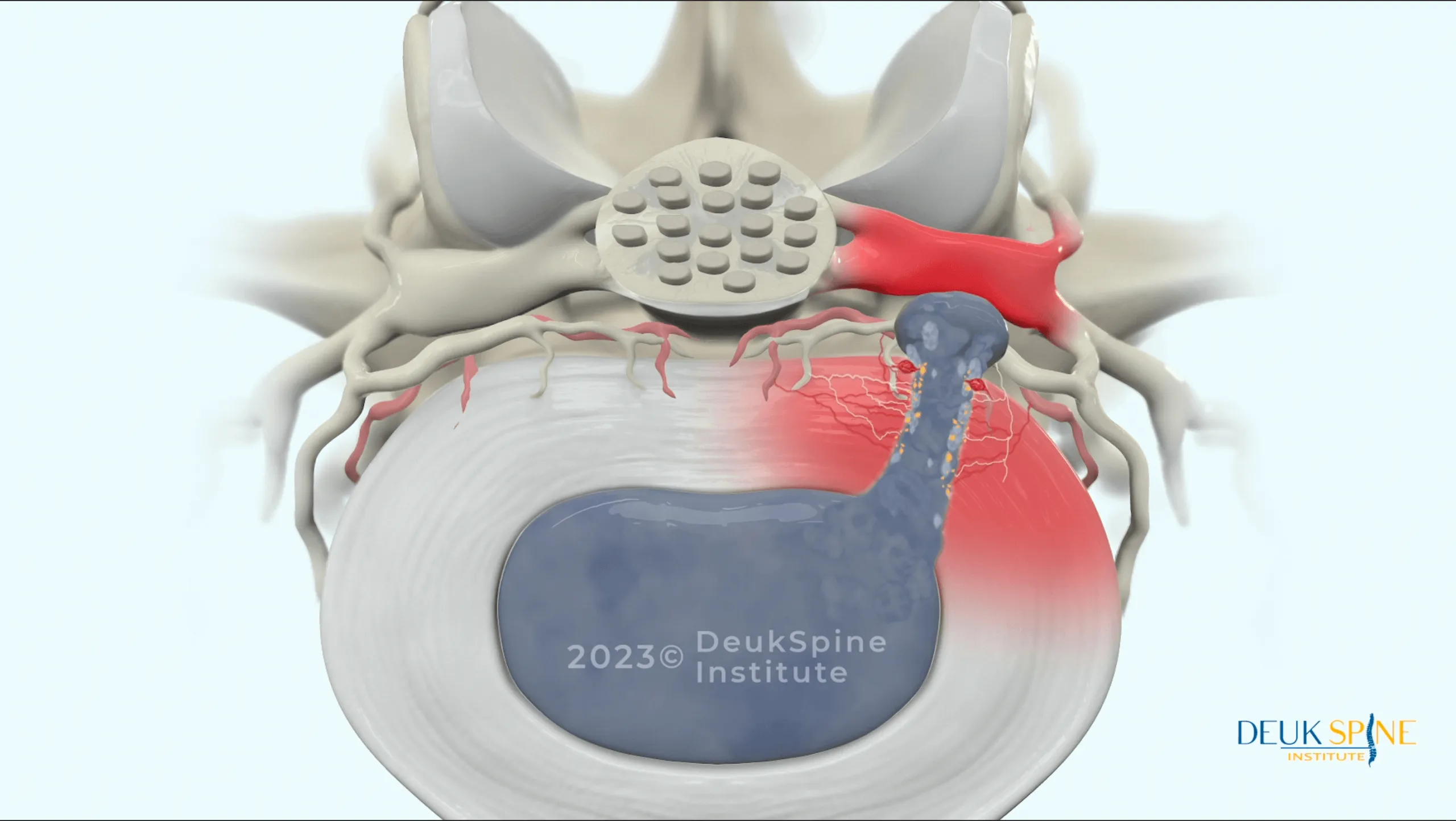 #19 Recurrent Disc Herniation .png