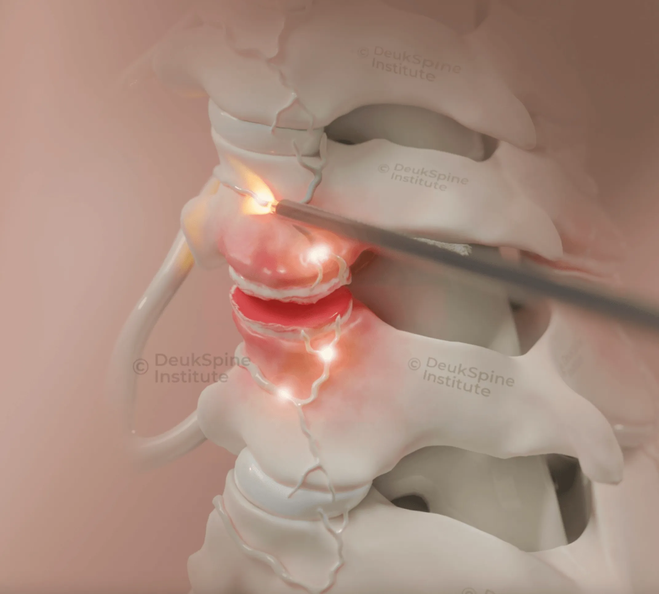 Animation showcasing deuk plasma wond burning the nerves completely to cure pain in the neck.