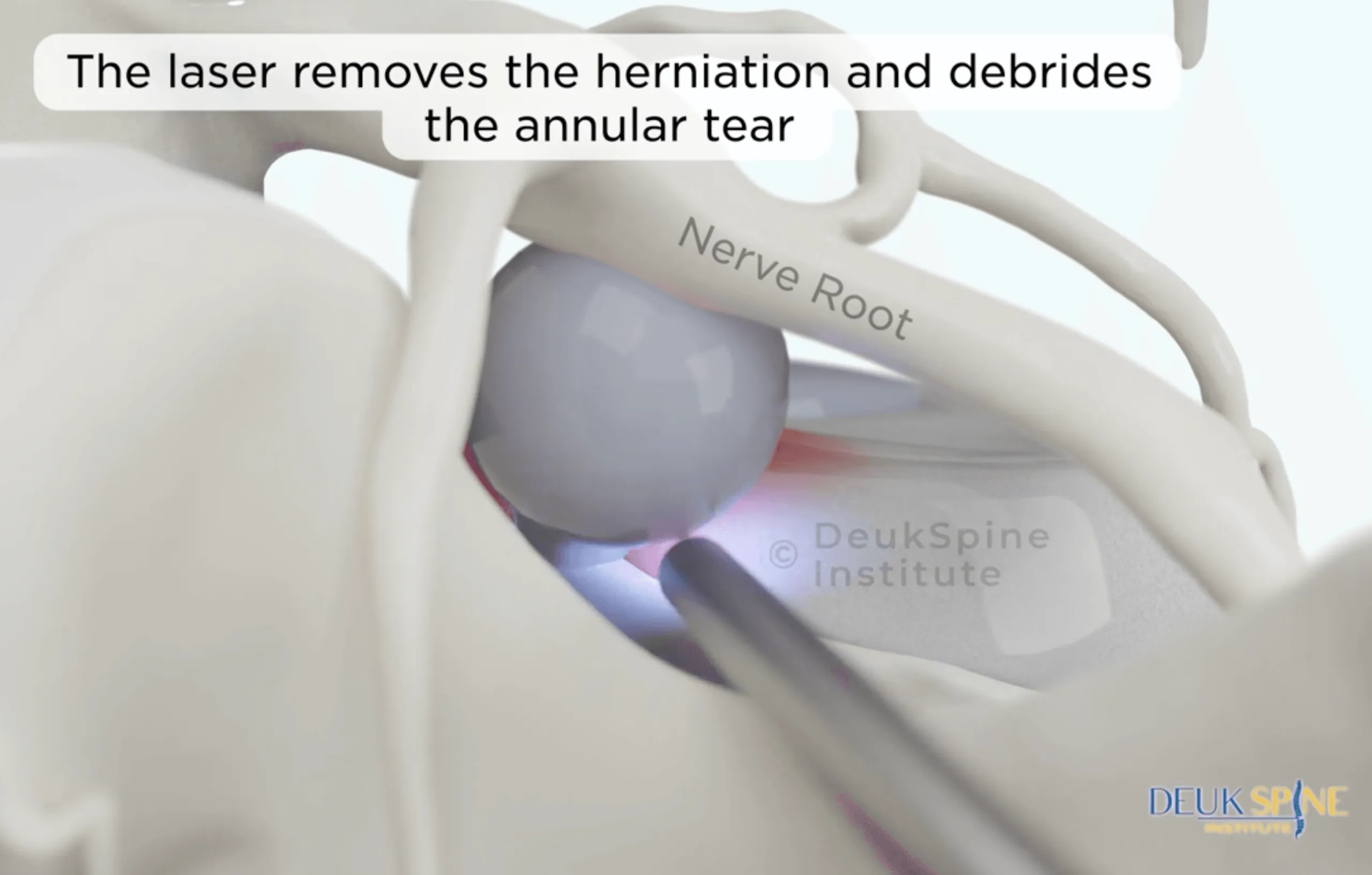 DLDR® Lumbar - 3D.png