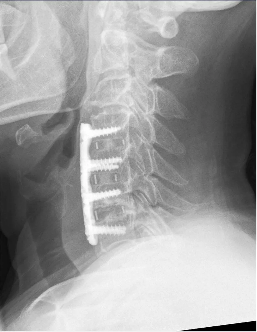 cervical fusion known as ACDF