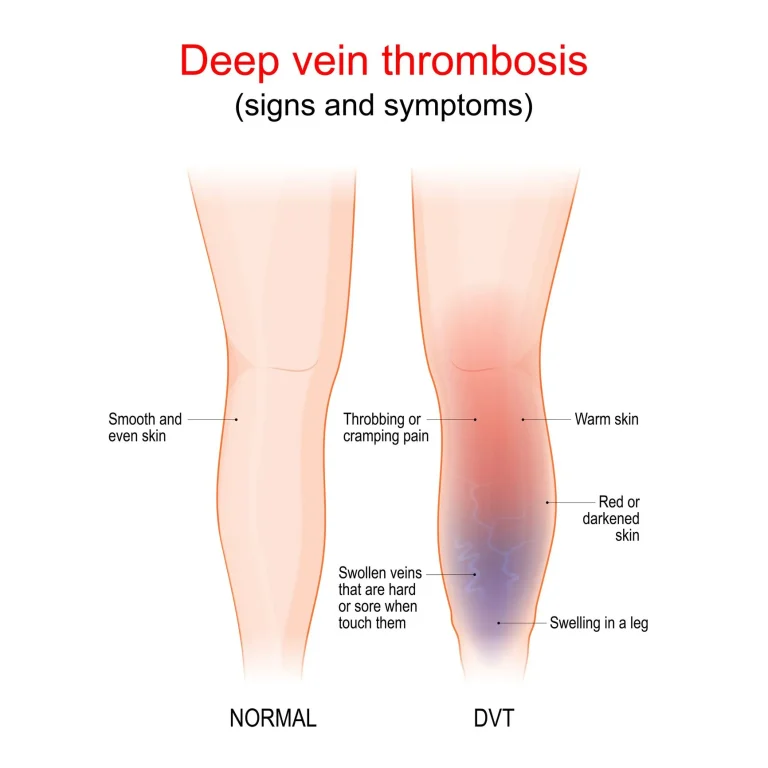 Comparison of normal leg and leg with deep vein thrombosis, showing symptoms like pain, swelling, and skin discoloration.