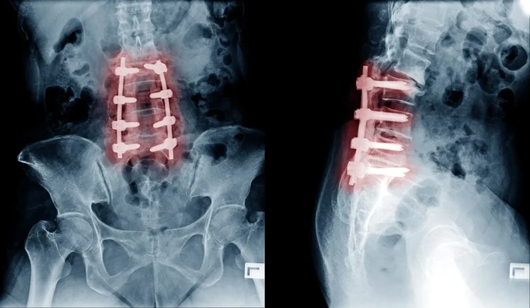 X-ray showing spinal fusion with metal implants in the lumbar region, both front and side views.