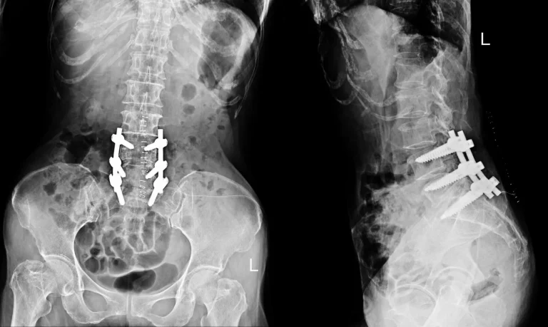 X-ray showing spinal fusion with metal screws and rods in the lower back.