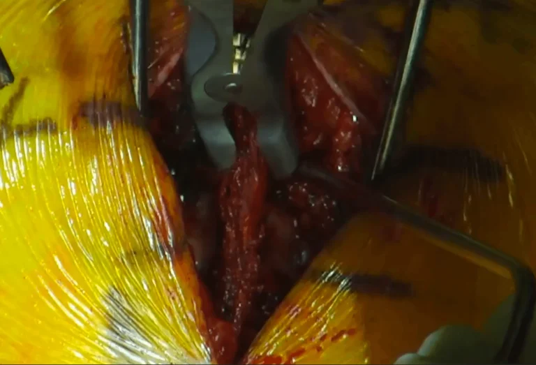 Close-up of an open surgical site with surgical tools and visible tissue.