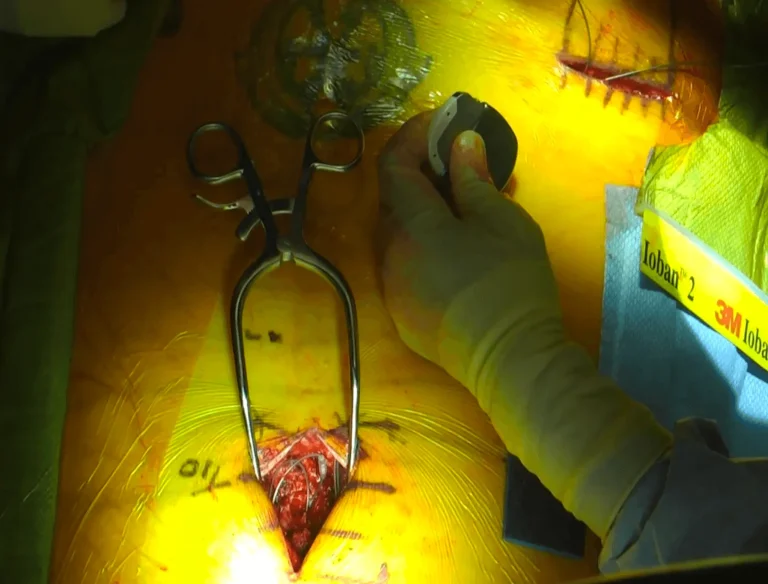 Surgical field with clamps and a device adjacent to an incision on a patient.