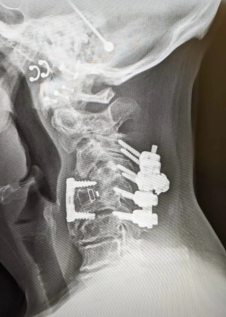 X-ray of a neck showing metal screws and plates in the cervical spine.