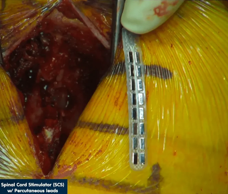 Close-up of a spinal cord stimulator implant procedure with visible leads.