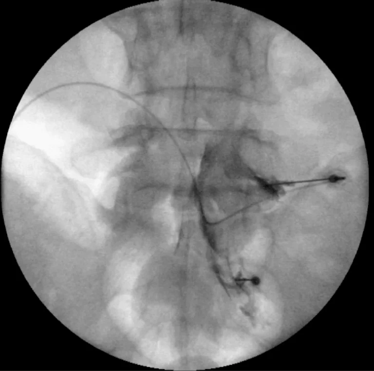 X-ray image showing a catheter inserted into blood vessels.
