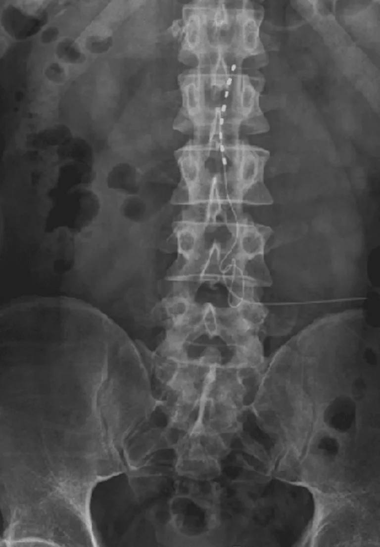X-ray showing a spinal cord stimulator with leads along the spine.