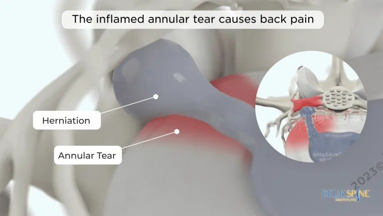 Diagram of an inflamed annular tear and herniation causing back pain with labeled details.