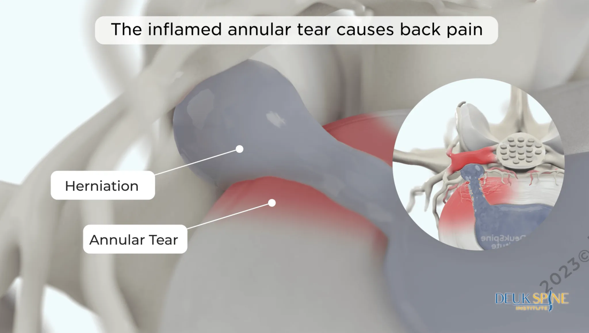 A herniated disc and an annular tear within the lumbar spine region, highlighted to demonstrate common causes of back pain, implying limitations of spinal fusion in treating these issues.