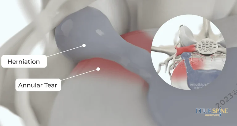 Diagram showing a spinal disc herniation and annular tear with labels.
