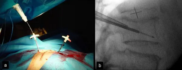 Surgical procedure showing needle insertion with accompanying X-ray guidance.