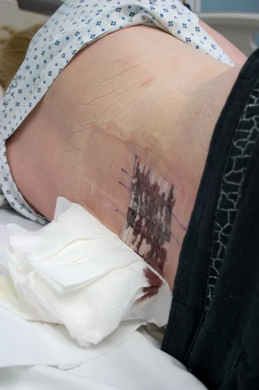 Person lying on their side with a bandaged wound on the torso and gauze nearby.