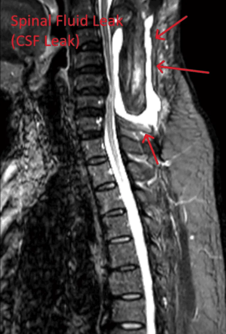 MRI image showing a spinal fluid leak with red arrows pointing to the affected area.
