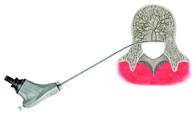 Illustration of a medical instrument inserted through bone structure with visible internal details.