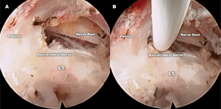 Endoscopic views of the L5 vertebra showing labeled pedicle, nerve root, and basivertebral nerve structures.