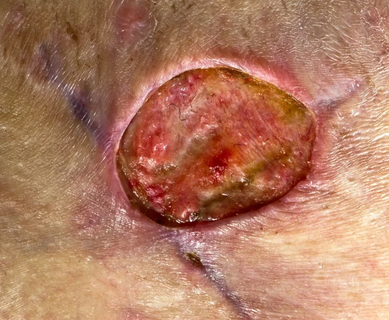 Close-up of a red, irritated, oval-shaped sore on skin.