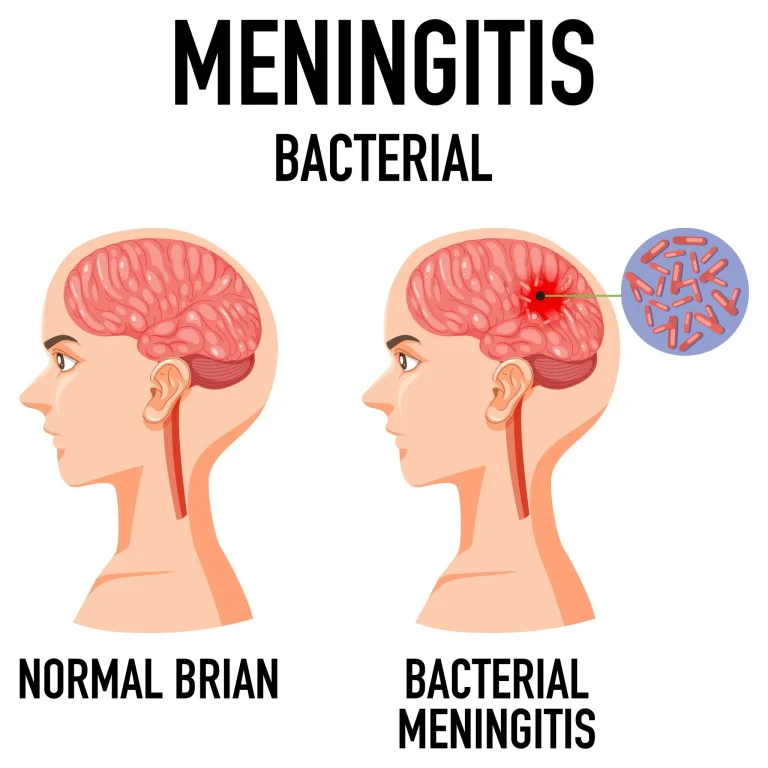 Side-by-side comparison of a normal brain and one with bacterial meningitis.