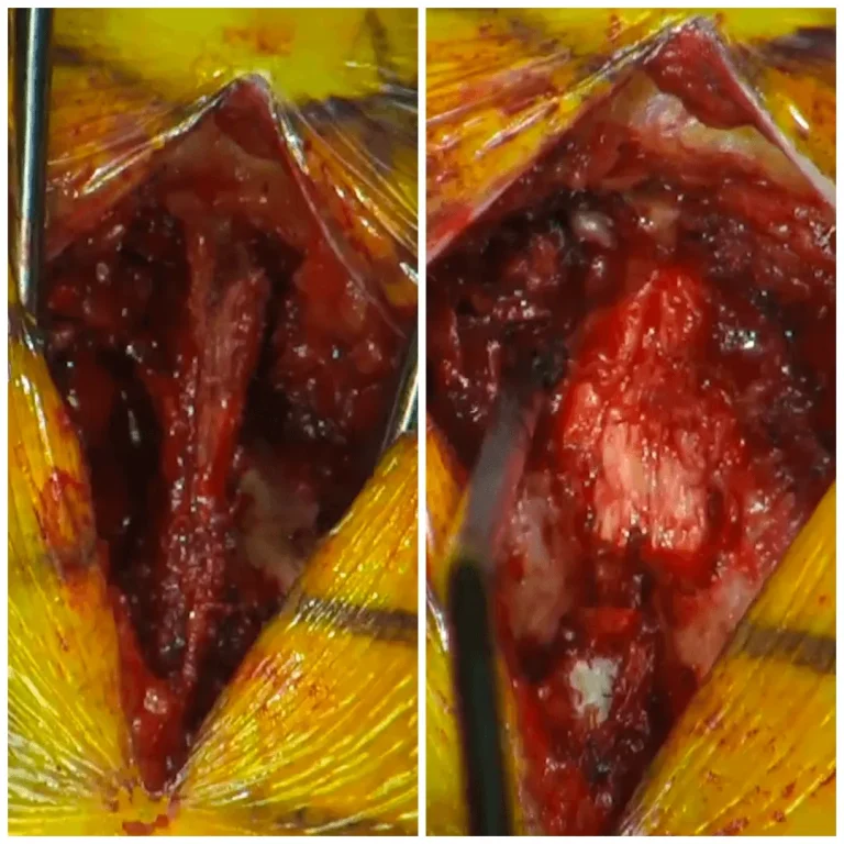 Close-up of a surgical incision showing exposed tissue in two comparison images.