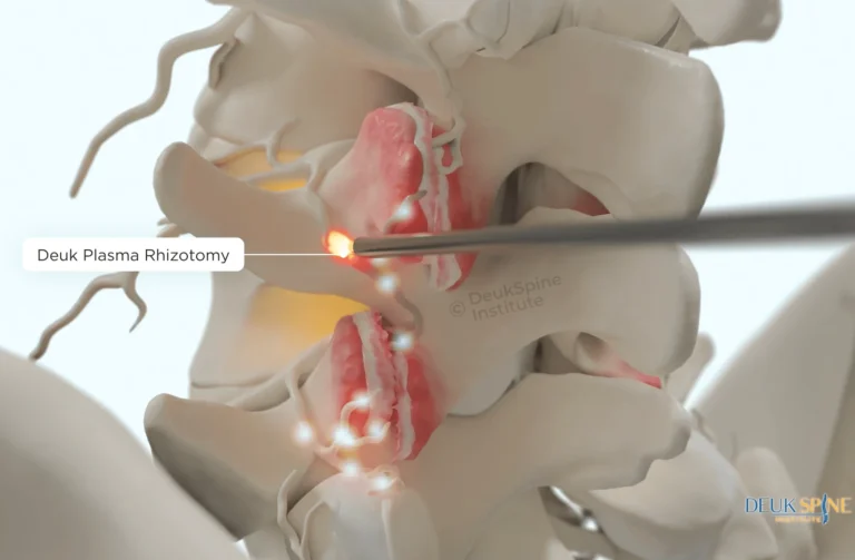 Illustration of Deuk Plasma Rhizotomy procedure on a spinal nerve.