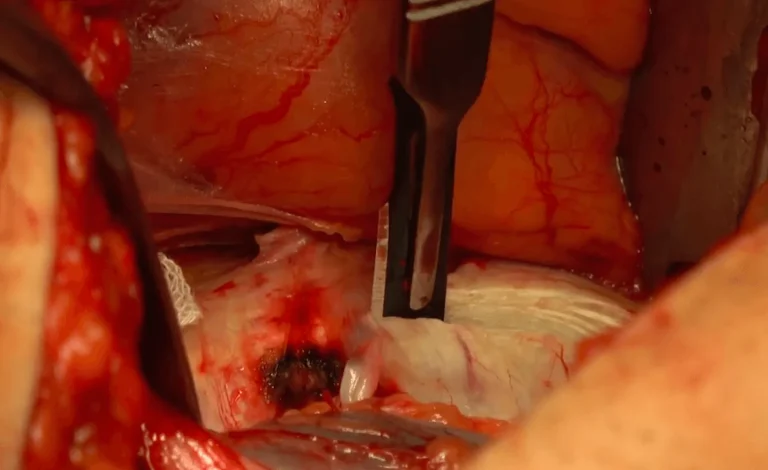 Surgical procedure with exposed tissue and tool in an incision site.