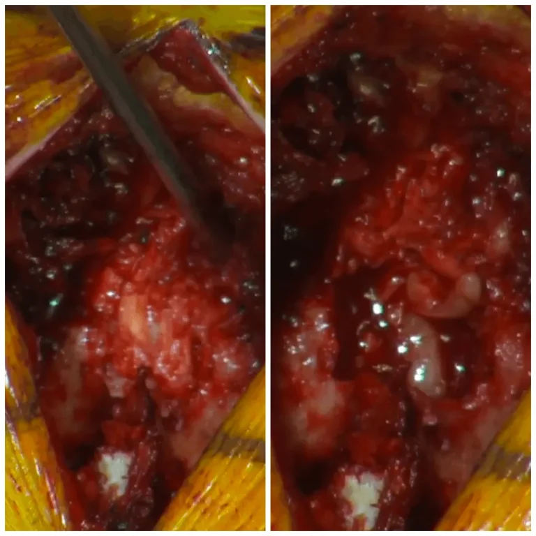 Close-up of a surgical incision with visible tissue and a scalpel in two images.