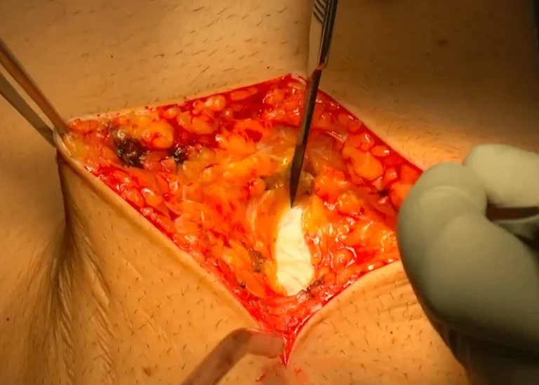 Surgical incision on skin with visible fat tissue and medical tools.