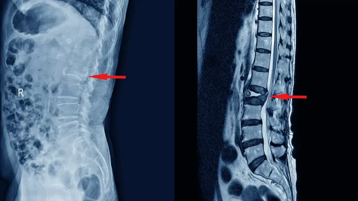 X-ray and MRI scans showing abnormalities in the spine, indicated by red arrows.