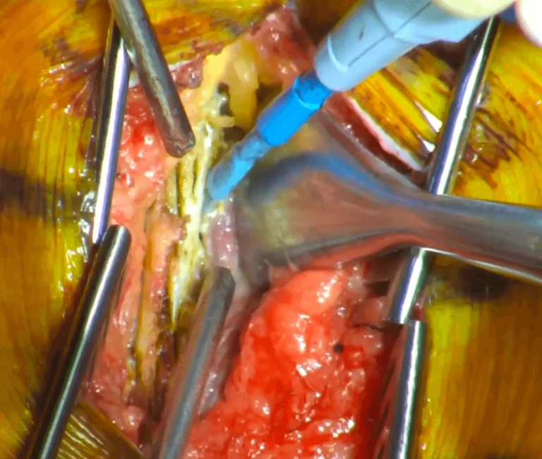 Surgical procedure with instruments exposing tissue and bone.