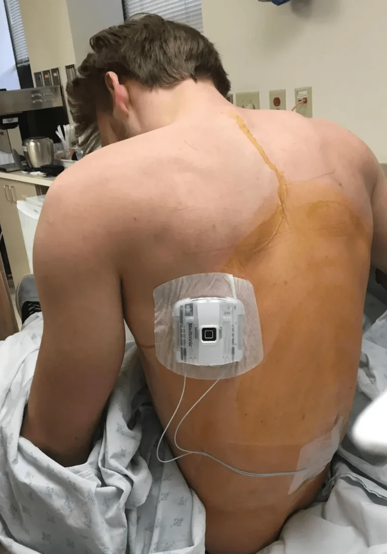 Man with medical device on his back in a clinical setting.