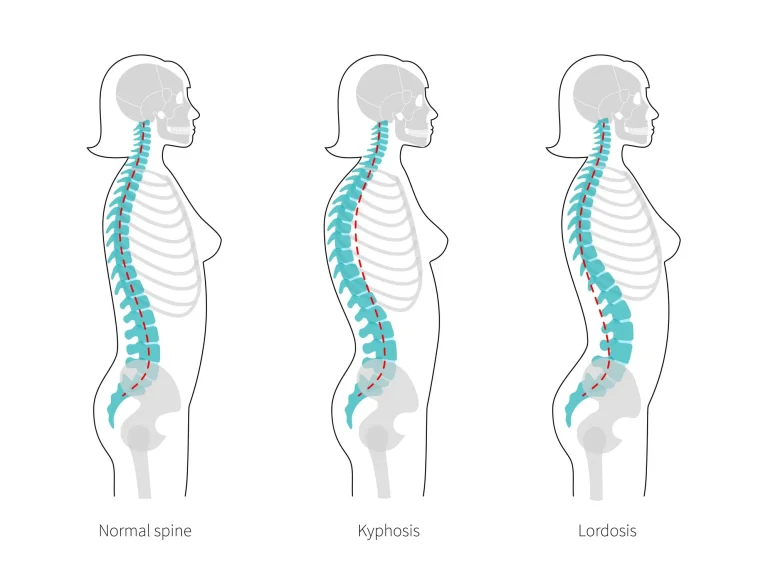 Illustration of normal spine, kyphosis, and lordosis side-by-side in silhouette form.