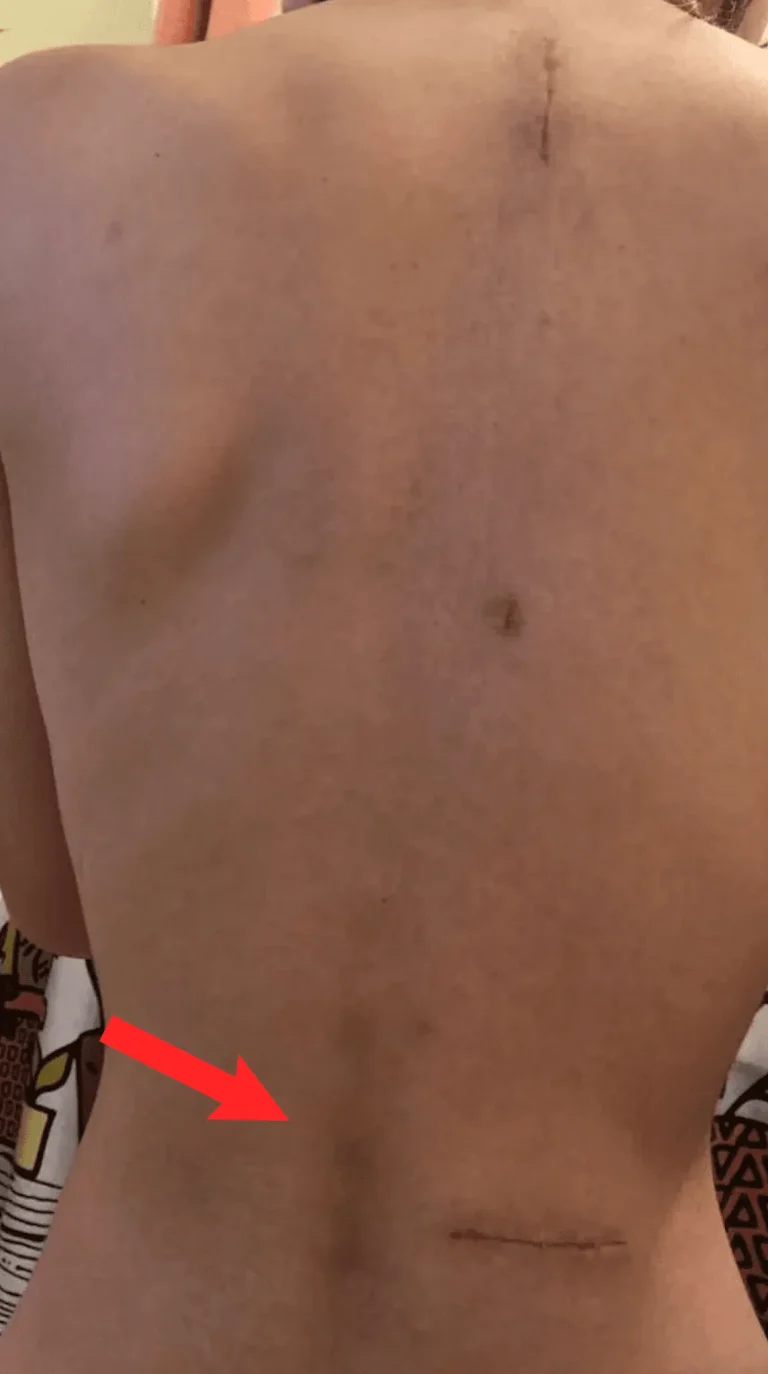 A person's back showing scars with a red arrow pointing to the lower one.