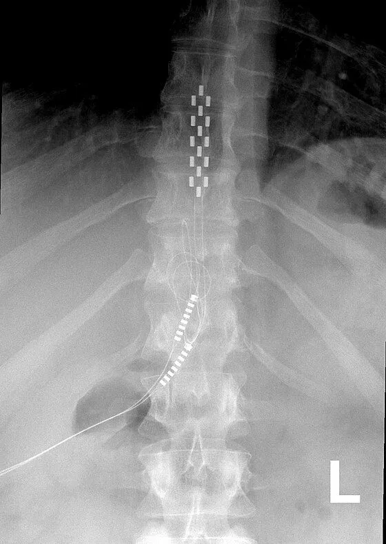X-ray image showing a spinal cord with a series of electrode implants.