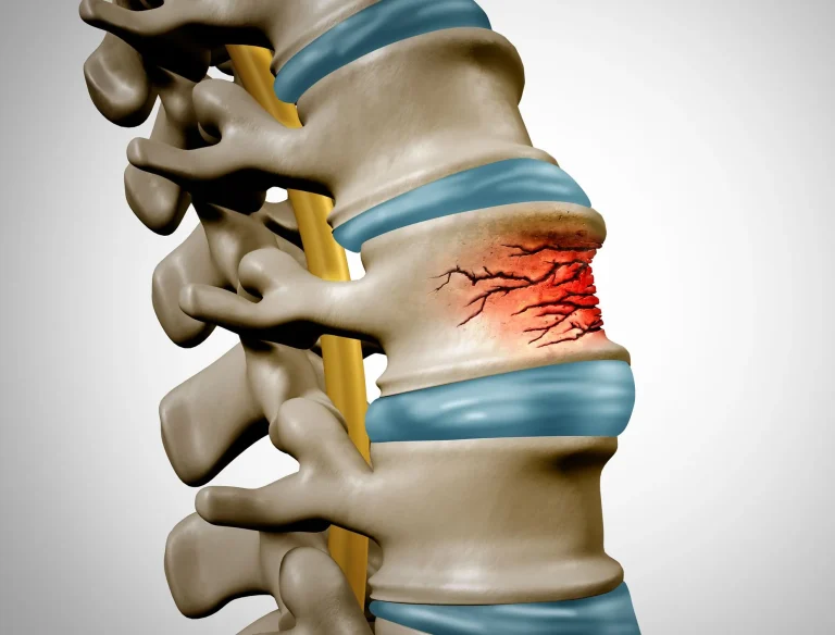 Illustration of a spine with a highlighted vertebra showing a red fracture.
